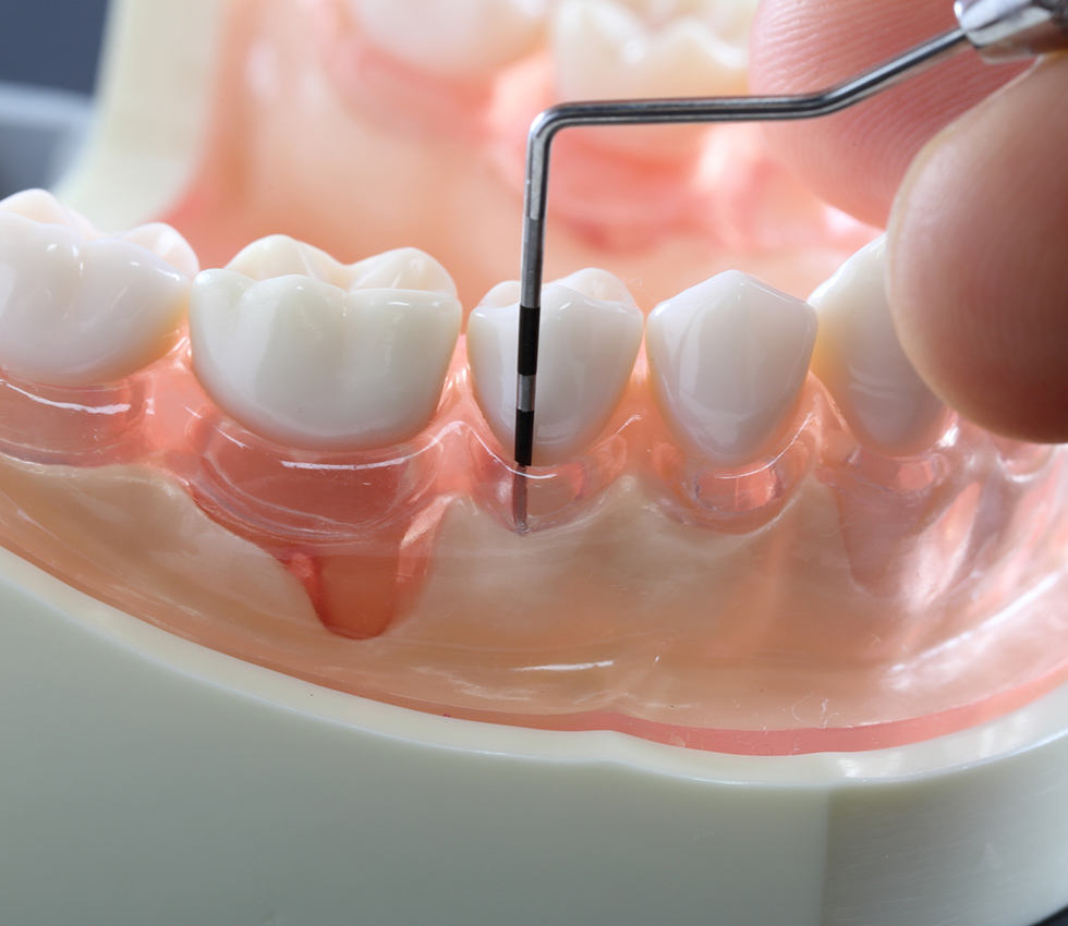 PERIODONTAL DISEASE