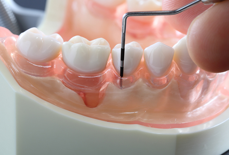 PERIODONTAL DISEASE