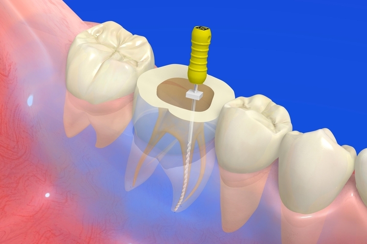 ROOT CANAL TREATMENT