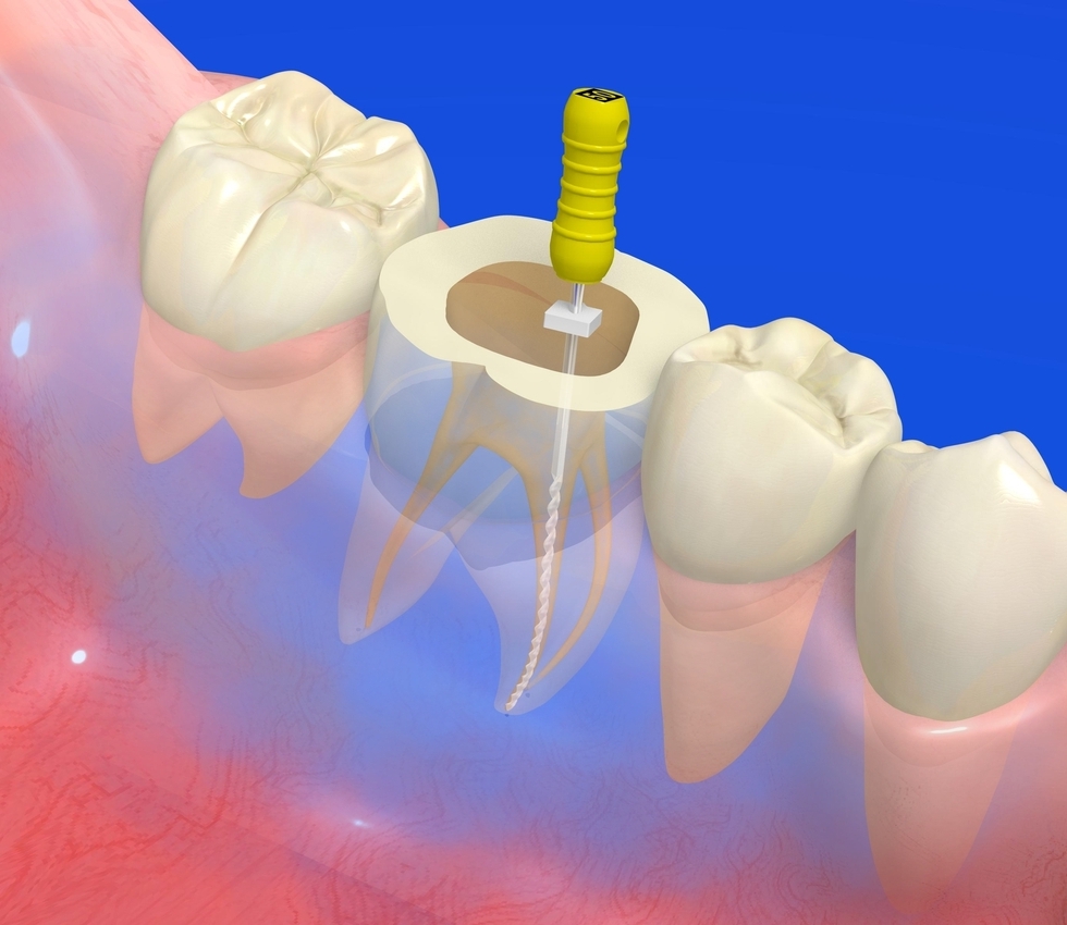 ROOT CANAL TREATMENT